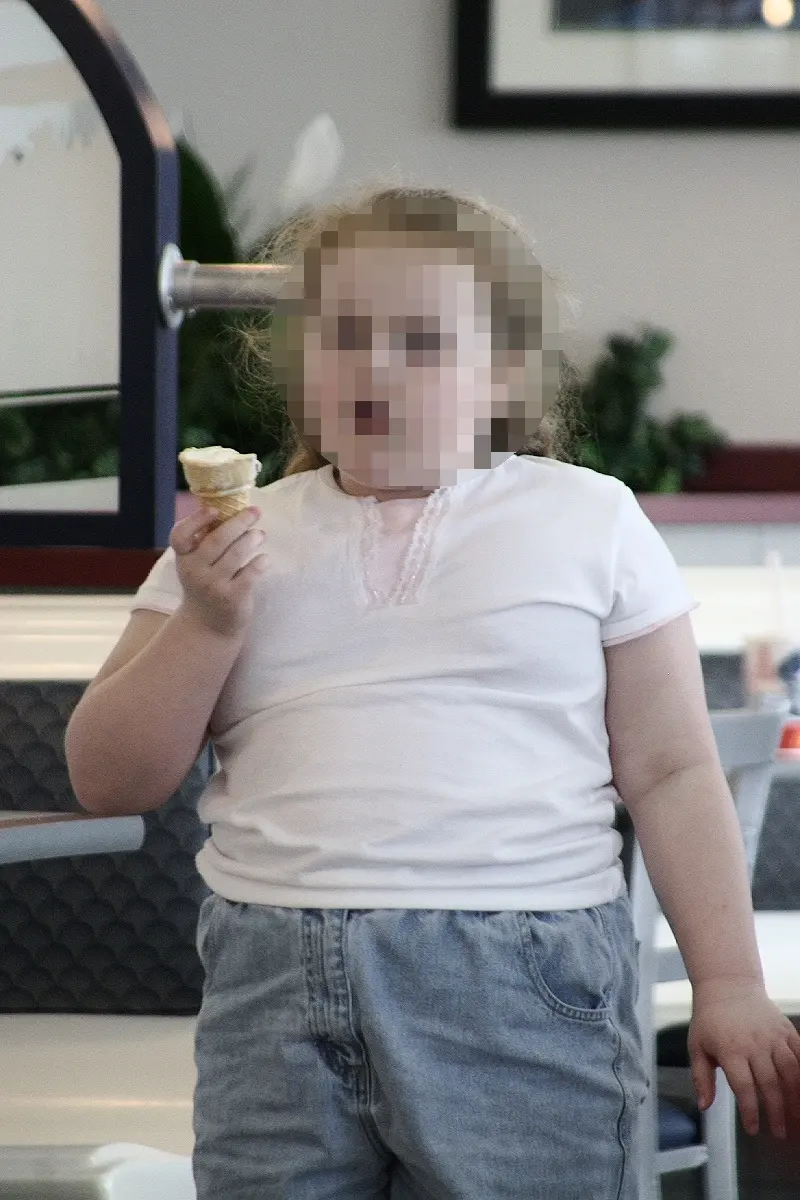 An example of childhood obesity.